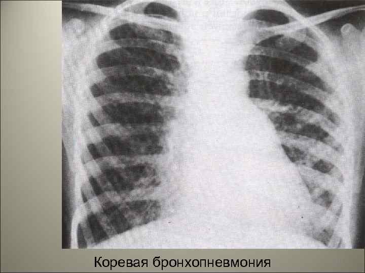 Коревая бронхопневмония 107 