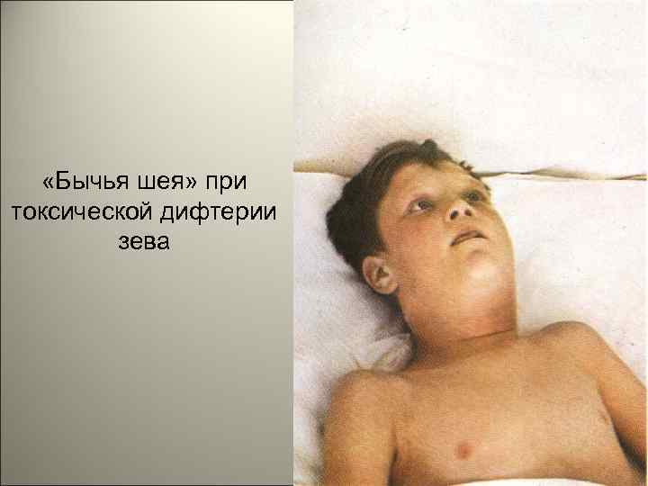 «Бычья шея» при токсической дифтерии зева 116 