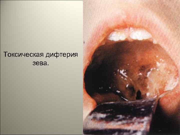 Токсическая дифтерия зева. 118 
