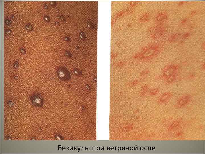 Везикулы при ветряной оспе 12 