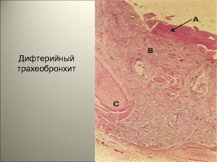 Дифтерийный трахеобронхит 122 