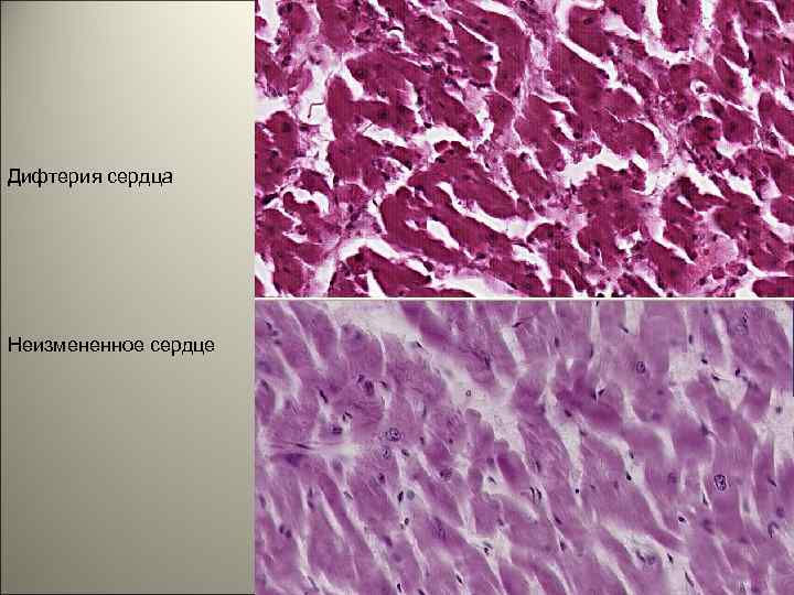 Дифтерия сердца Неизмененное сердце 128 