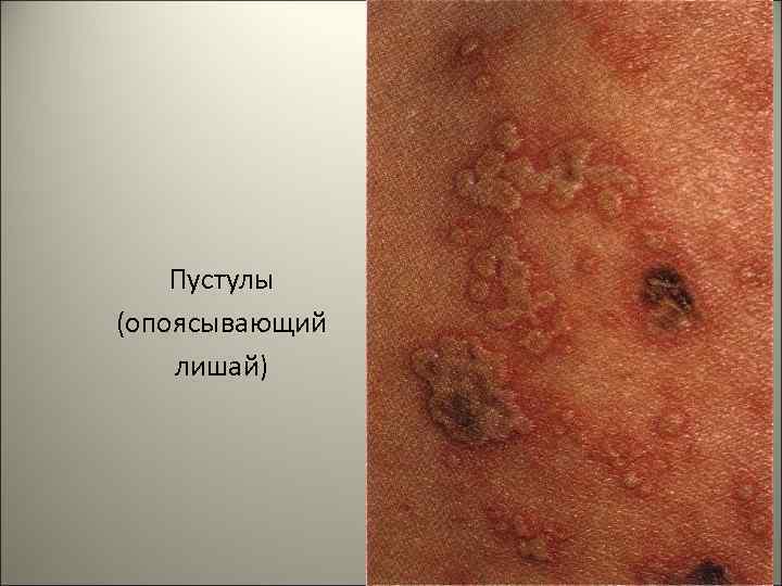 Пустулы (опоясывающий лишай) 13 