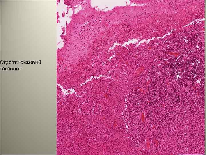 Стрептококковый тонзилит 140 