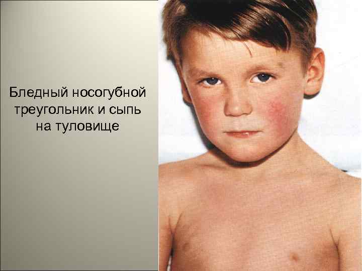 Бледный носогубной треугольник и сыпь на туловище 143 