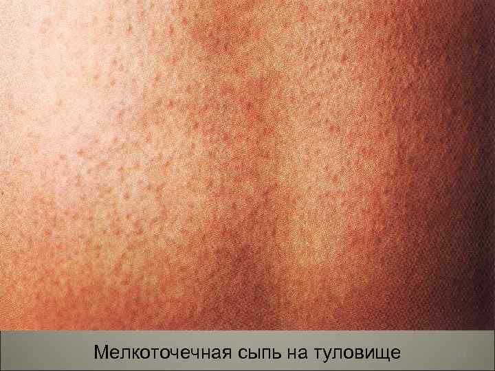 Мелкоточечная сыпь на туловище 144 