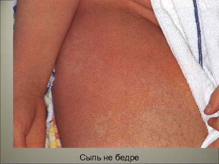 Сыпь не бедре 145 