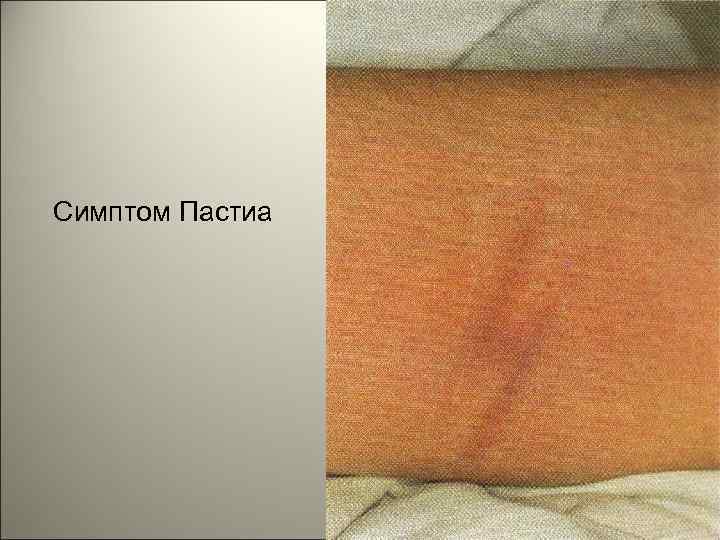 Симптом Пастиа 146 