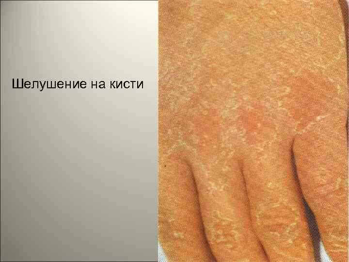 Шелушение на кисти 147 