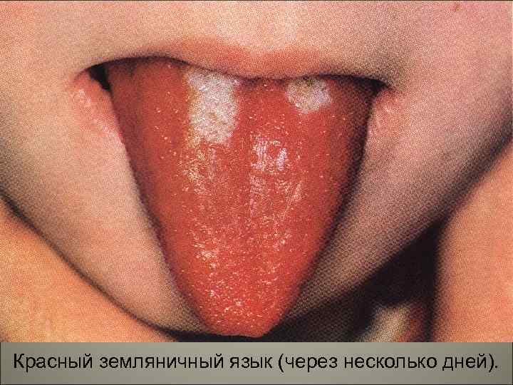 Красный земляничный язык (через несколько дней). 150 