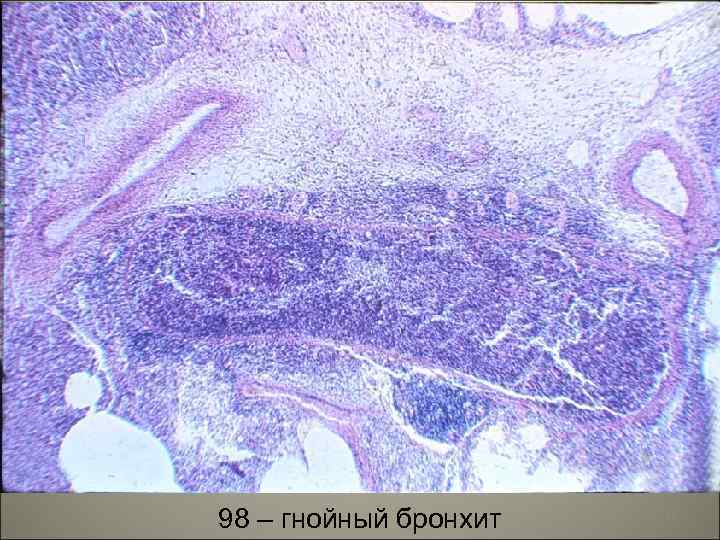 98 – гнойный бронхит 23 