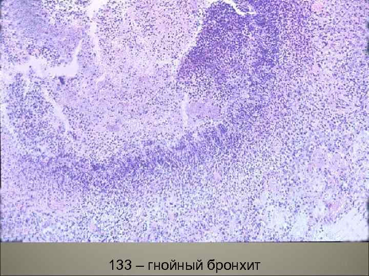 133 – гнойный бронхит 24 
