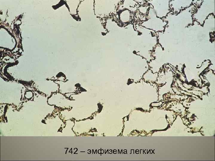 742 – эмфизема легких 35 