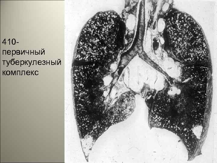 410 первичный туберкулезный комплекс 5 