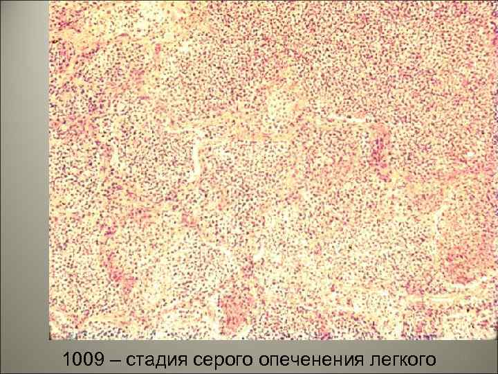 1009 – стадия серого опеченения легкого 52 