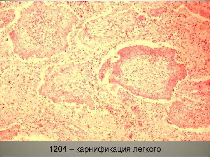 1204 – карнификация легкого 57 