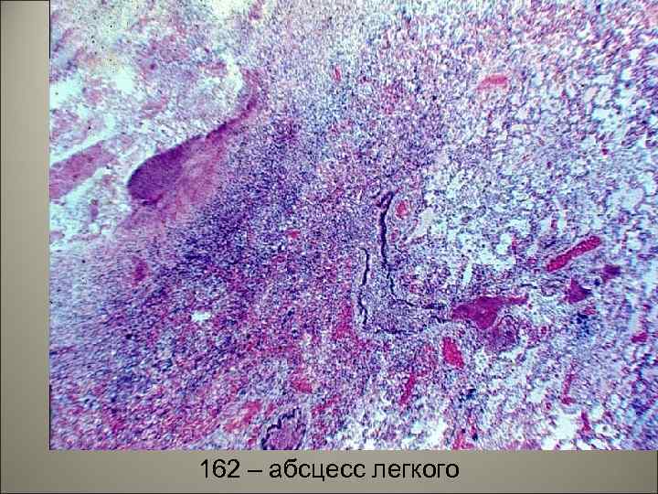 162 – абсцесс легкого 59 