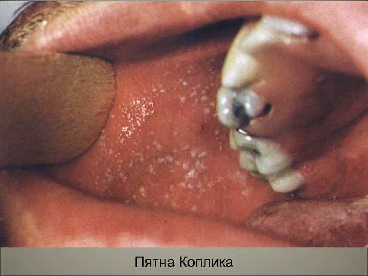 Пятна Коплика 94 