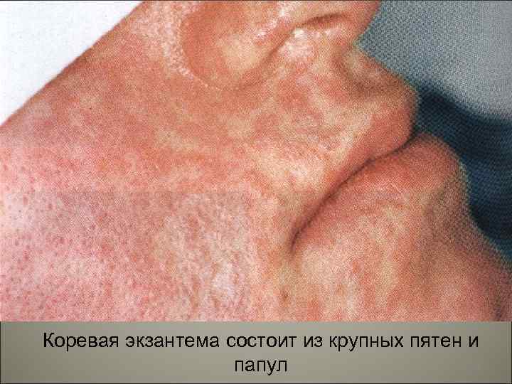 Коревая экзантема состоит из крупных пятен и 98 папул 