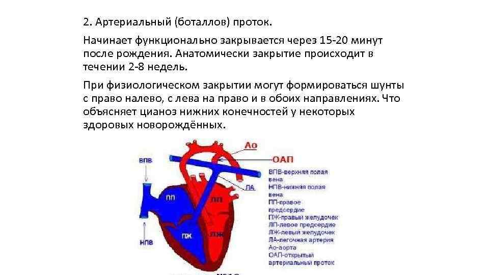 Открытый артериальный проток у детей