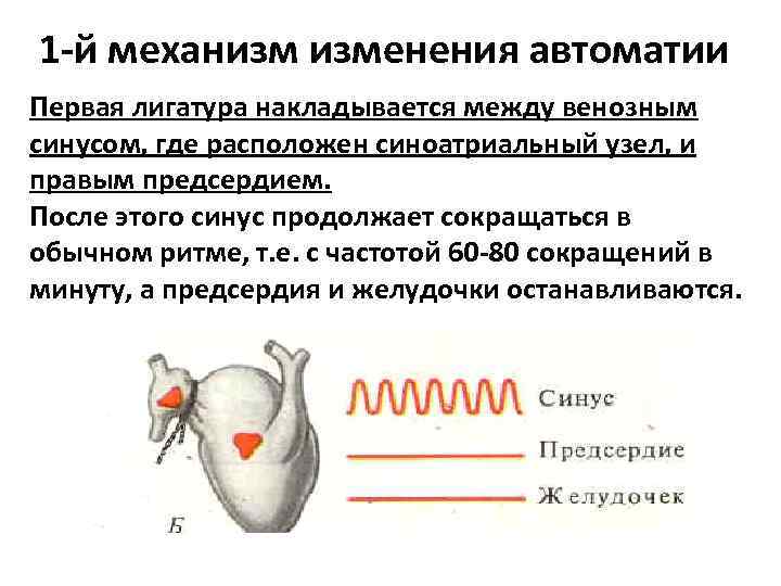 Схема наложения лигатур