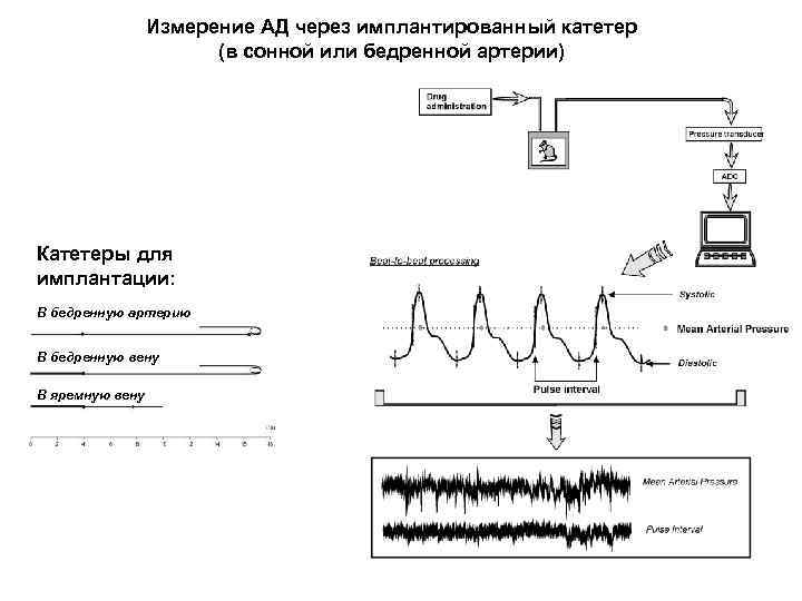 Измерение АД через имплантированный катетер (в сонной или бедренной артерии) Катетеры для имплантации: В