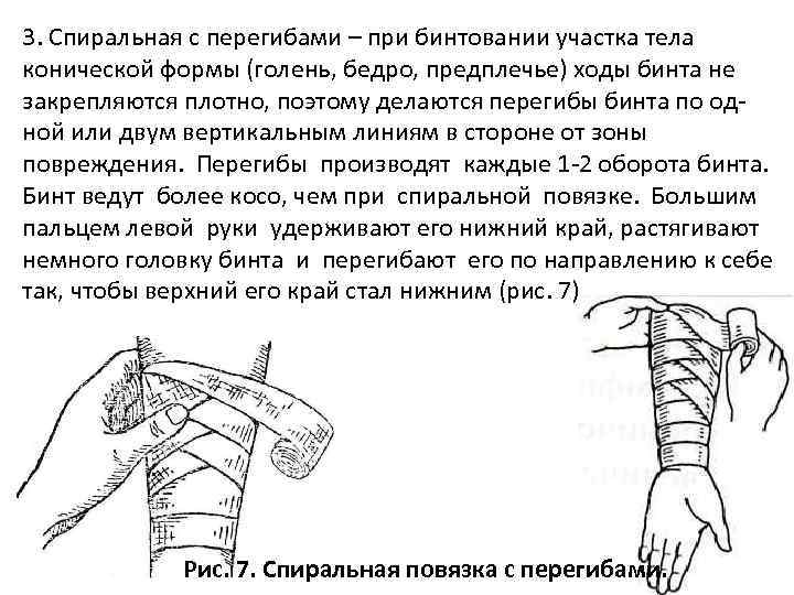 3. Спиральная с перегибами – при бинтовании участка тела конической формы (голень, бедро, предплечье)