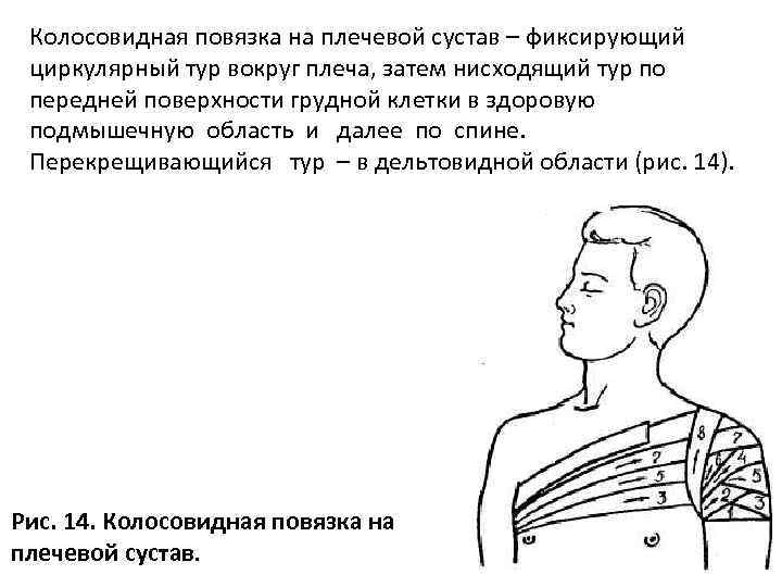 Колосовидная повязка на плечевой сустав – фиксирующий циркулярный тур вокруг плеча, затем нисходящий тур