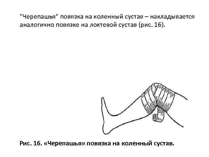 "Черепашья" повязка на коленный сустав – накладывается аналогично повязке на локтевой сустав (рис. 16).