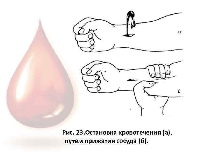 а б Рис. 23. Остановка кровотечения (а), путем прижатия сосуда (б). 