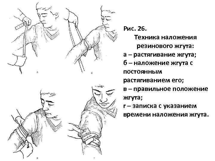 Рис. 26. Техника наложения резинового жгута: а – растягивание жгута; б – наложение жгута
