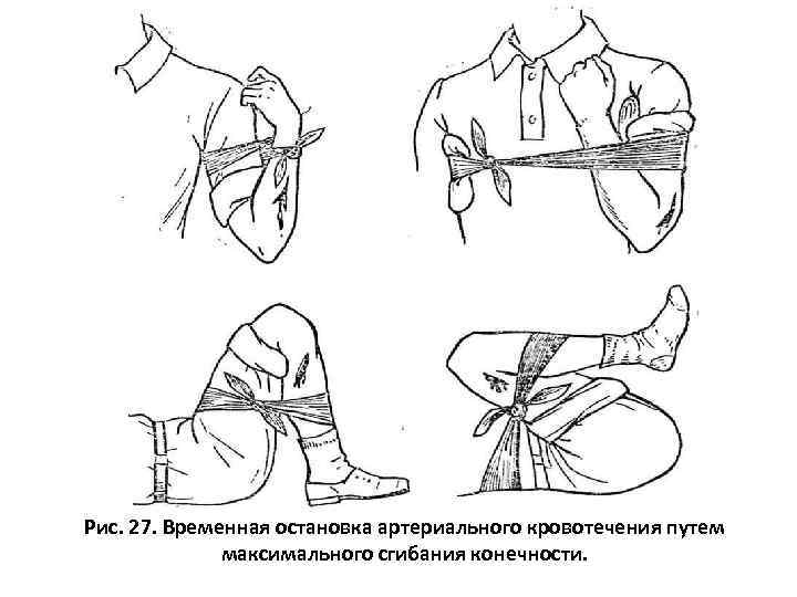 Рис. 27. Временная остановка артериального кровотечения путем максимального сгибания конечности. 