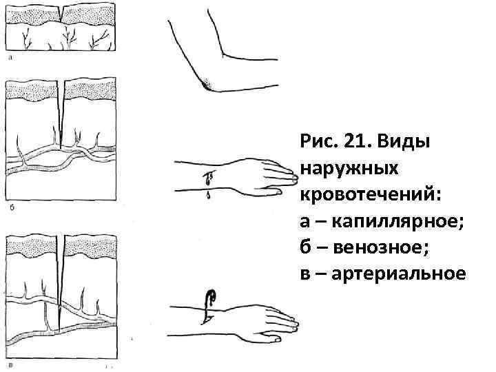 Рис. 21. Виды наружных кровотечений: а – капиллярное; б – венозное; в – артериальное