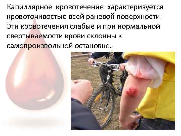 Капиллярное кровотечение характеризуется кровоточивостью всей раневой поверхности. Эти кровотечения слабые и при нормальной свертываемости