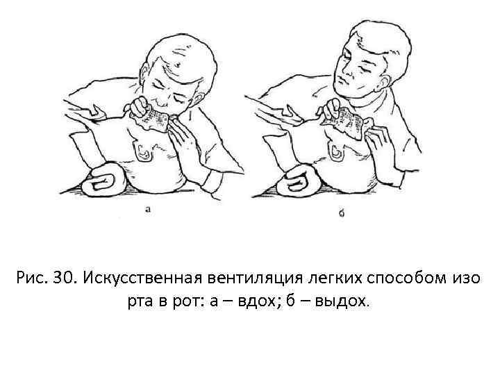 Рис. 30. Искусственная вентиляция легких способом изо рта в рот: а – вдох; б