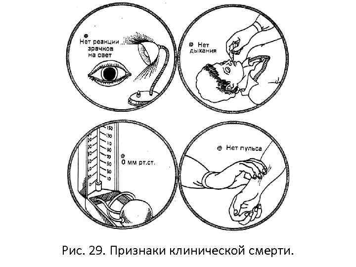 Рис. 29. Признаки клинической смерти. 