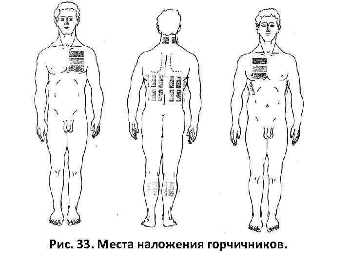 Рис. 33. Места наложения горчичников. 