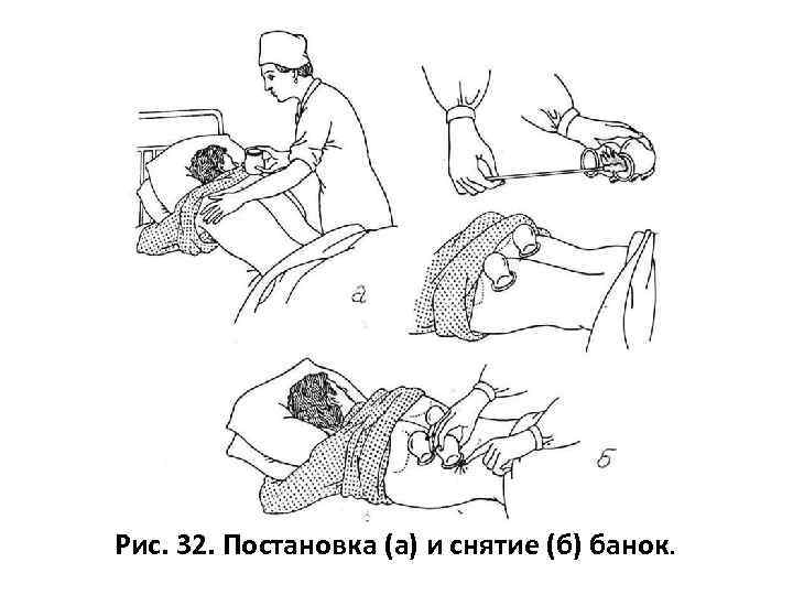 Рис. 32. Постановка (а) и снятие (б) банок. 