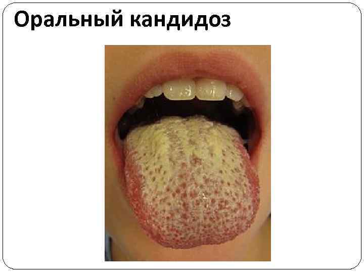 Оральный кандидоз 