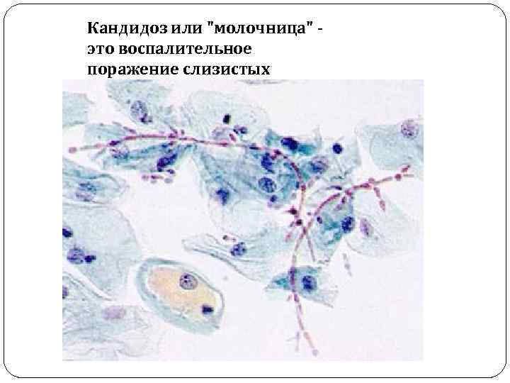 Кандидоз или "молочница" это воспалительное поражение слизистых 