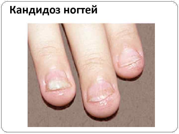 Кандидоз ногтей 