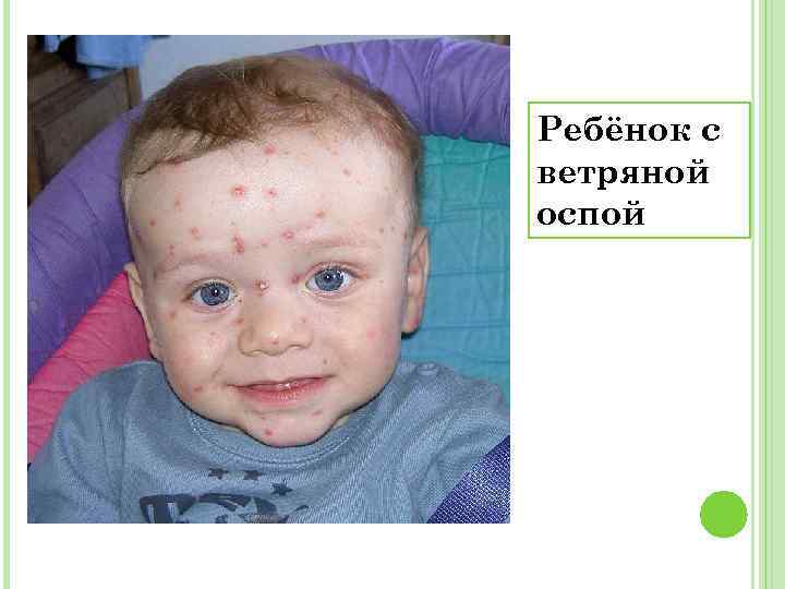 Ребёнок с ветряной оспой 