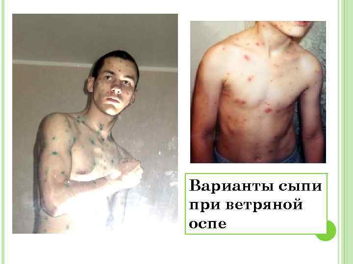 Варианты сыпи при ветряной оспе 