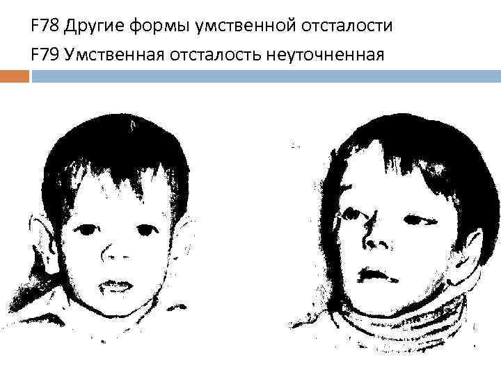 F 78 Другие формы умственной отсталости F 79 Умственная отсталость неуточненная 