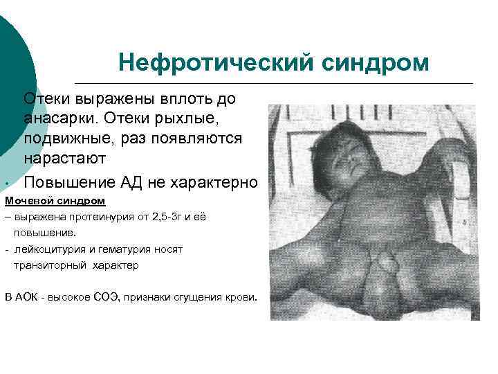 Нефротический синдром • • Отеки выражены вплоть до анасарки. Отеки рыхлые, подвижные, раз появляются