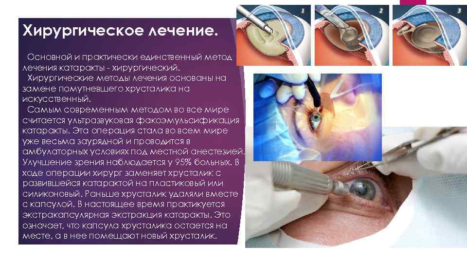 Хирургическое лечение. Основной и практически единственный метод лечения катаракты - хирургический. Хирургические методы лечения