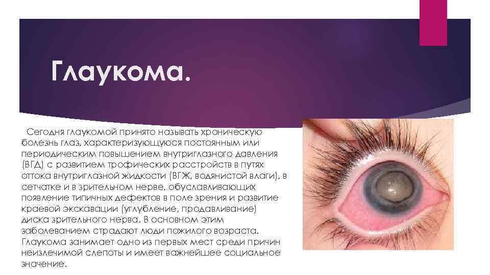 Глаукома. Сегодня глаукомой принято называть хроническую болезнь глаз, характеризующуюся постоянным или периодическим повышением внутриглазного