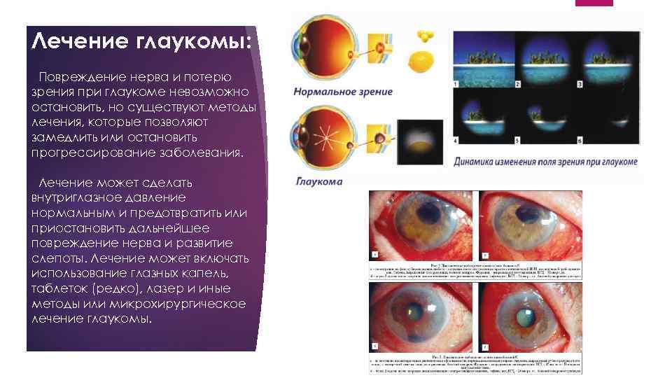 Лечение глаукомы: Повреждение нерва и потерю зрения при глаукоме невозможно остановить, но существуют методы