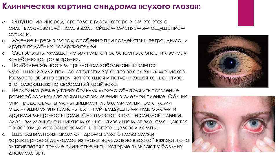 Клиническая картина синдрома «сухого глаза» : o o o Ощущение инородного тела в глазу,
