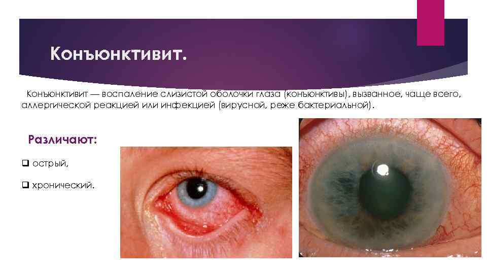 Конъюнктивит — воспаление слизистой оболочки глаза (конъюнктивы), вызванное, чаще всего, аллергической реакцией или инфекцией